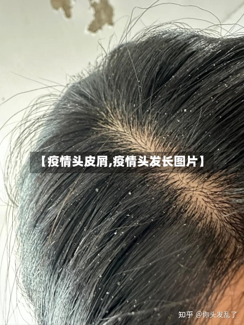 【疫情头皮屑,疫情头发长图片】