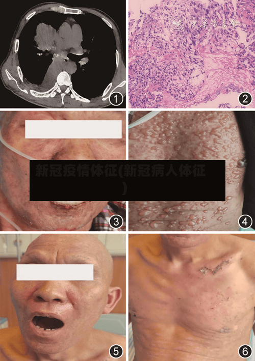 新冠疫情体征(新冠病人体征)